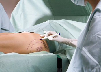 Ліпосакція в Україні та Європі. Як людство змінює ставлення до ліпосакції. Сучасні погляди на пластичну операцію