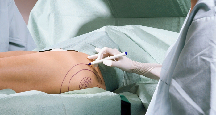 Ліпосакція в Україні та Європі. Як людство змінює ставлення до ліпосакції. Сучасні погляди на пластичну операцію