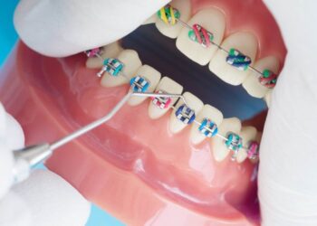 Особенности установки брекетов: каких правил необходимо придерживаться