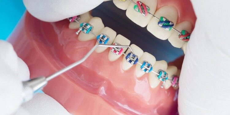 Особенности установки брекетов: каких правил необходимо придерживаться