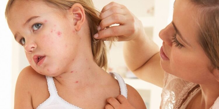Как вылечить чесотку у ребенка: полезные советы по выбору препаратов