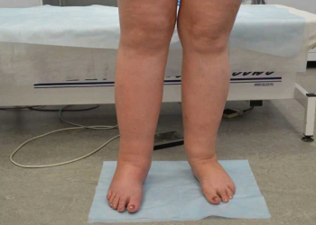 Лимфедема голени: понятие, первые симптомы и чем опасно