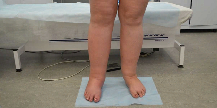 Лимфедема голени: понятие, первые симптомы и чем опасно