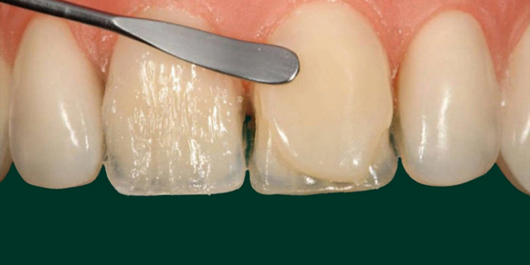 Техники наращивания зубов: способы, правила и рекомендации