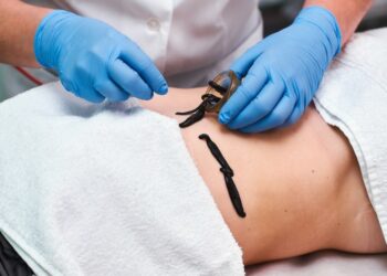 Главные особенности и преимущества гирудотерапии: что нужно знать