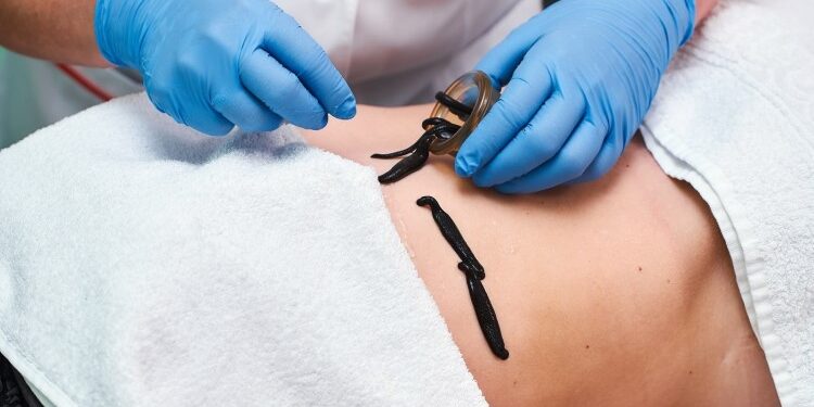 Главные особенности и преимущества гирудотерапии: что нужно знать