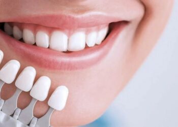 Виниры: их главные преимущества и особенности процесса установки