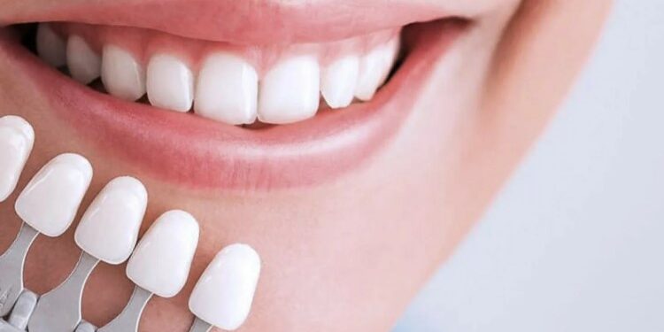 Виниры: их главные преимущества и особенности процесса установки