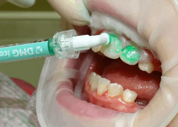 Лечение кариеса зубов: варианты, правила и рекомендации