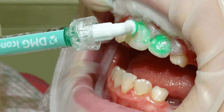 Лечение кариеса зубов: варианты, правила и рекомендации