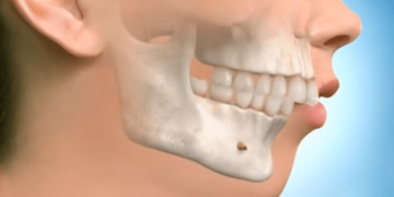 Почему важно восстанавливать зубы: изменения в челюсти после потери