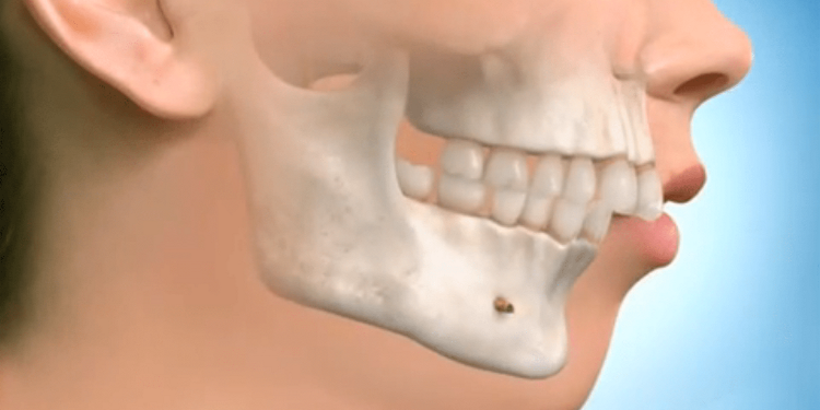 Почему важно восстанавливать зубы: изменения в челюсти после потери